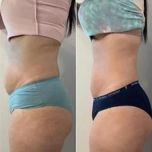 Anti-Cellulite Massage Roller