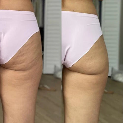 Anti-Cellulite Massage Roller